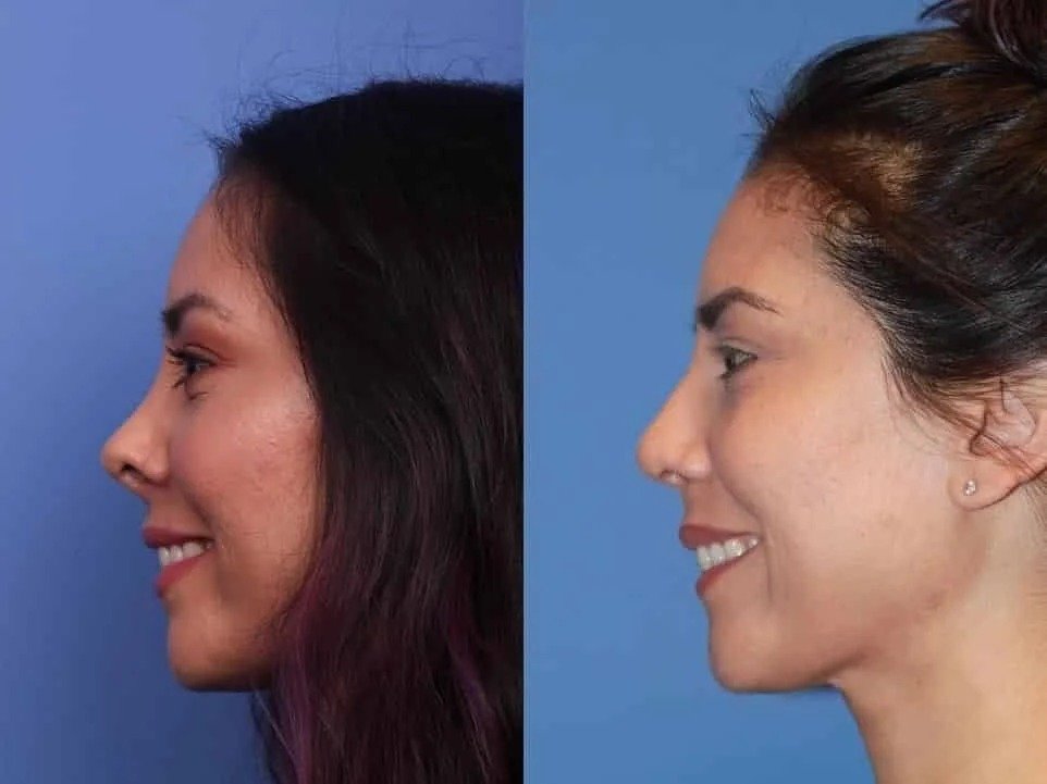 Rhinoplasty in Hinjewadi